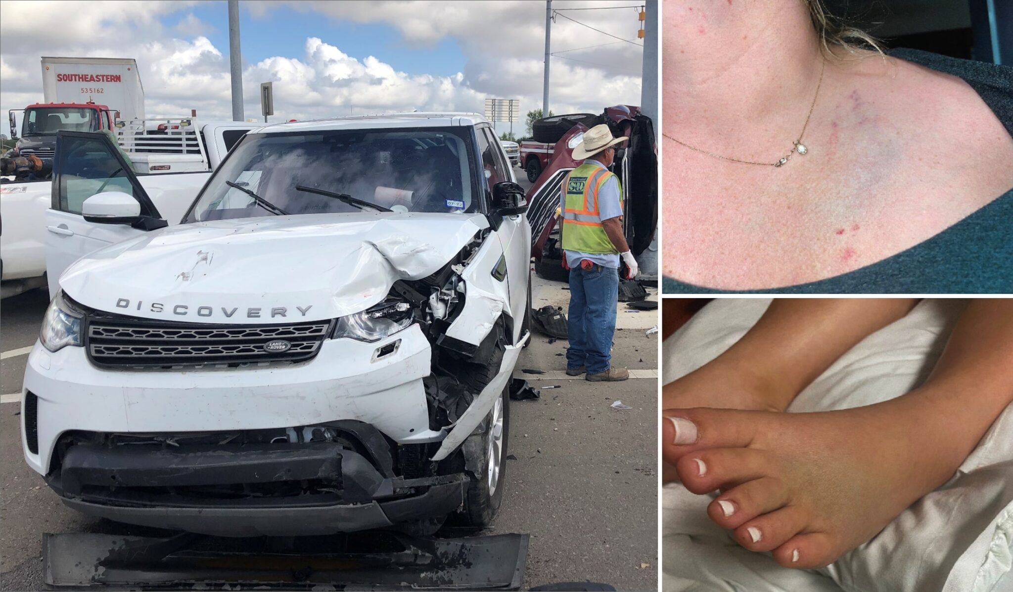 An SUV with driver's side damage, a close-up of bruising on the neck, and broken toes