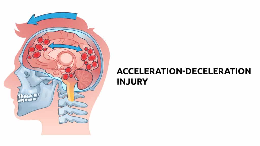 infographic showing a side view drawing of a brain illustrating acceleration-deceleration injury or shaken baby syndrome 