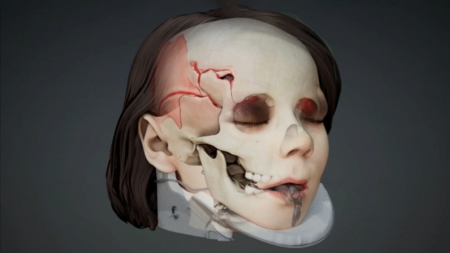 Illustration of tbi to right side of skull on a young girl