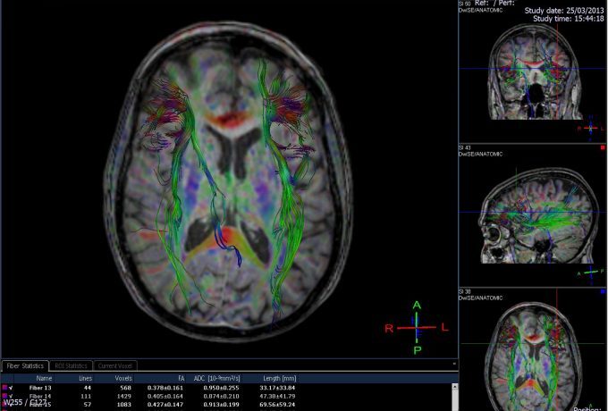 Litigating Traumatic Brain Injury Cases – a Presentation by Thomas A. Crosley