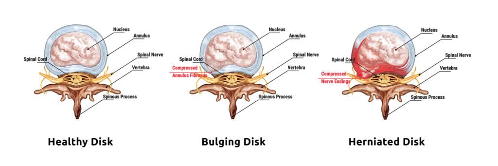 Can a Car Accident Cause a Bulging Disc
