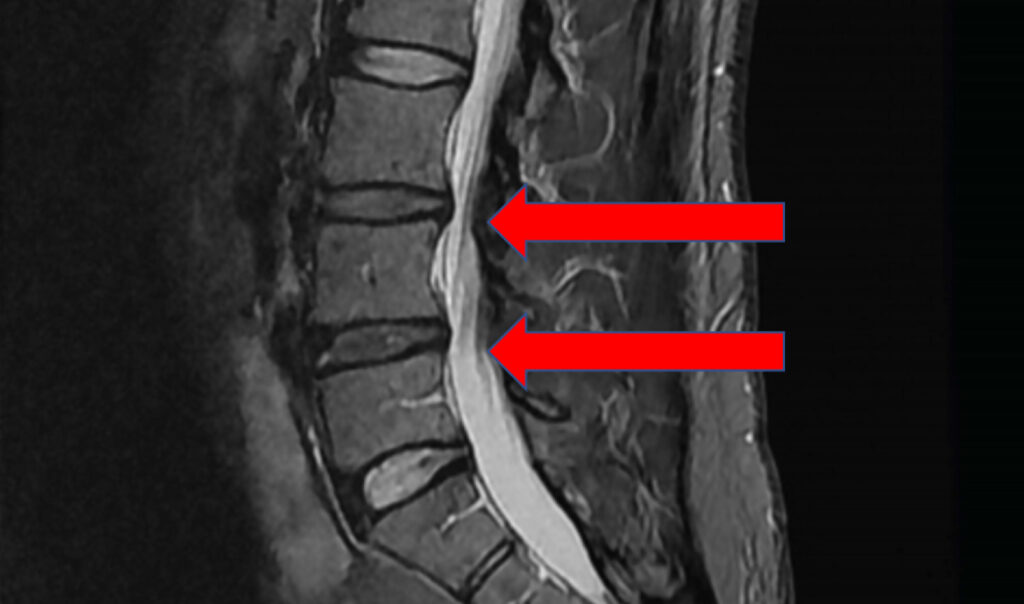 X-ray of radiculopathy in spine.