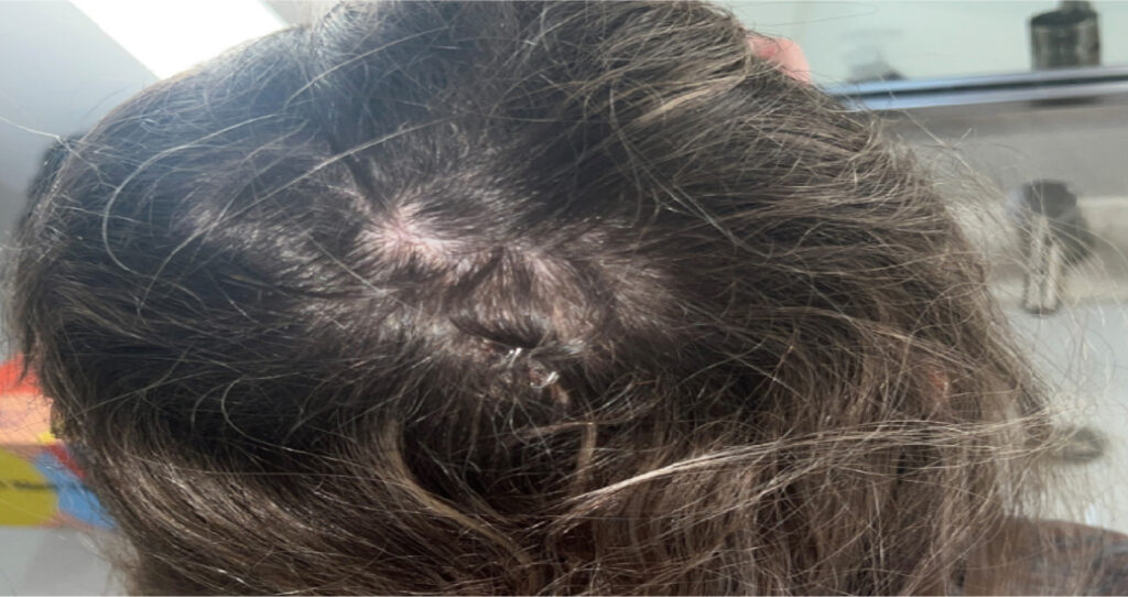 Lauren required surgical staples to close her head wound after being hit by a car.