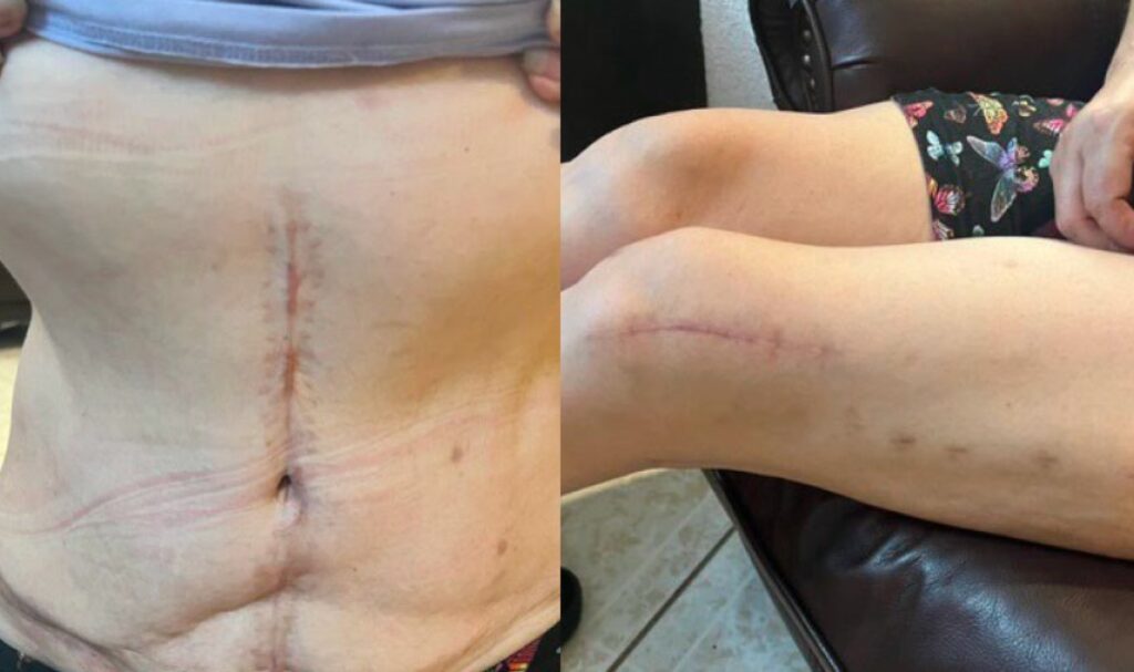 a close up of scars on the abdomen and knee