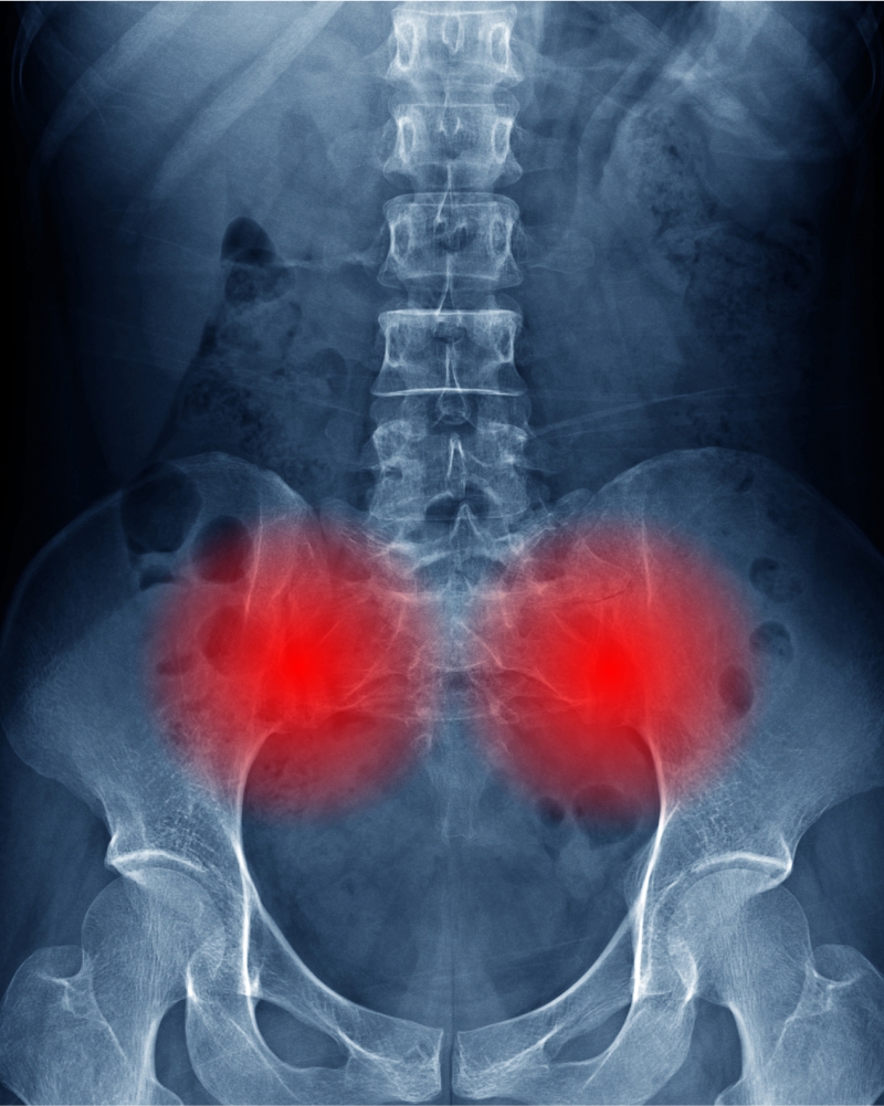 x-ray of the pelvis with the sacroiliac (SI) joint highlighted in red on both sides