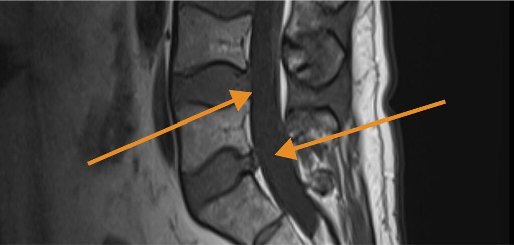imaging of an injury involving removal of herniated disc fragments, enlarging of nerve openings to relieve pressure on nerve roots, and ablation (burning) of damaged nerve fibers