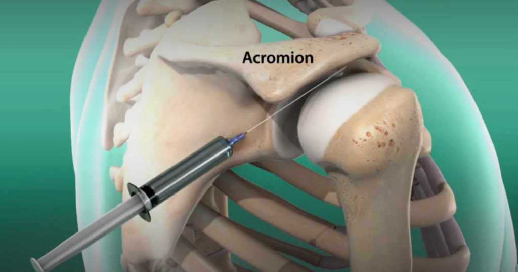 Jesse underwent multiple injections and imaging for his shoulder, wrist, and spine pain.