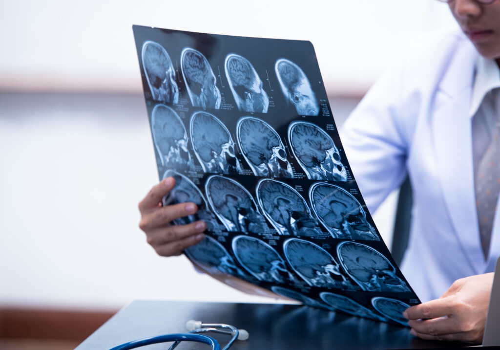 Medical professional examining a series of brain MRI scans, analyzing neurological images on a transparent film, with a stethoscope on the table beside them.
