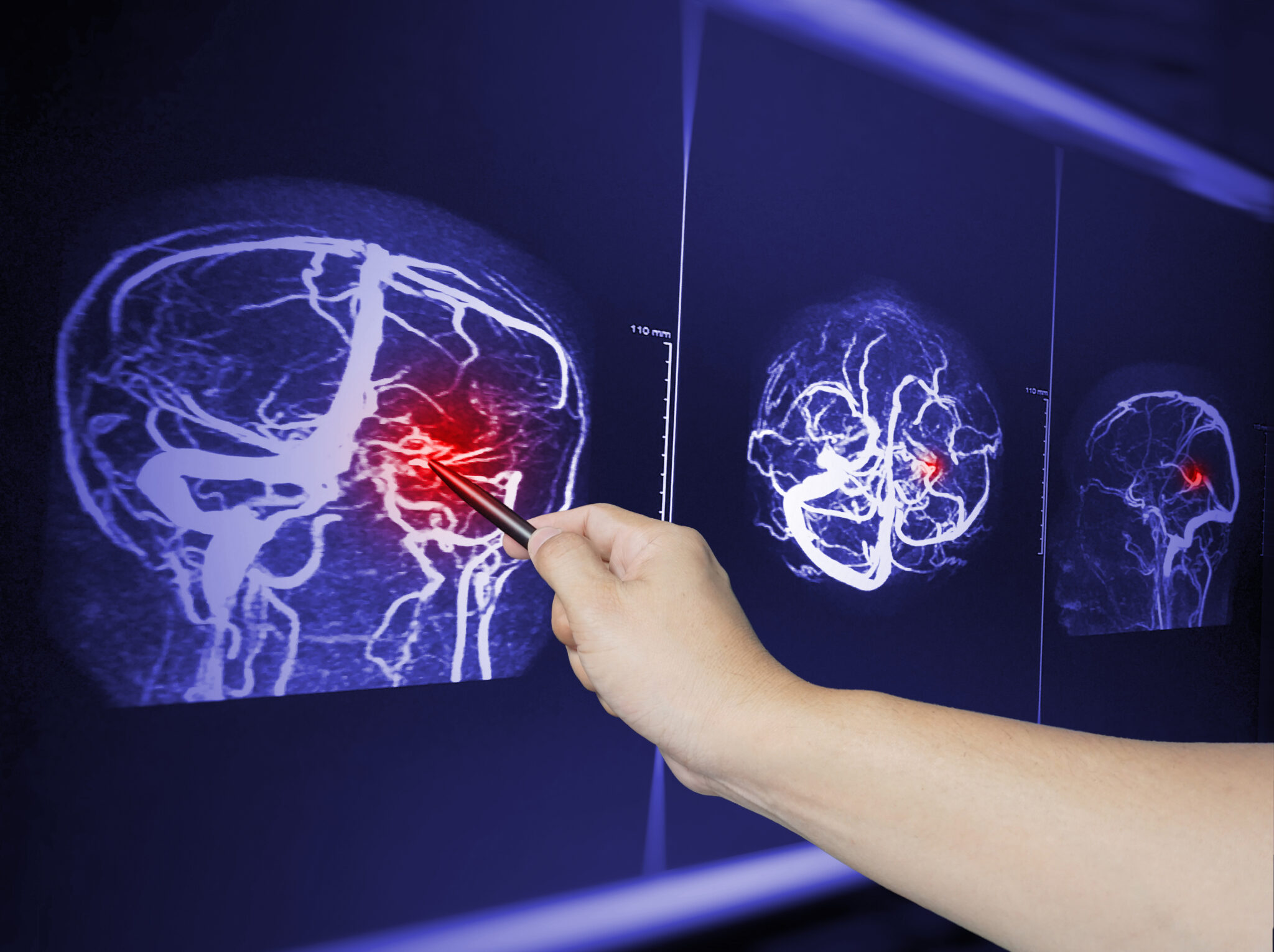 Medical professional pointing at a brain imaging scan on a monitor, highlighting a red area indicating possible brain injury.