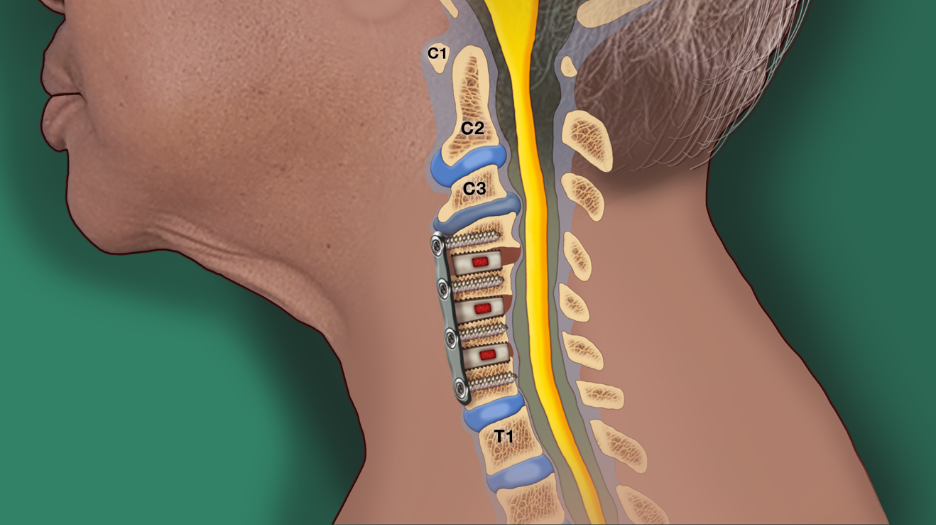 An illustration of a cervical injurie