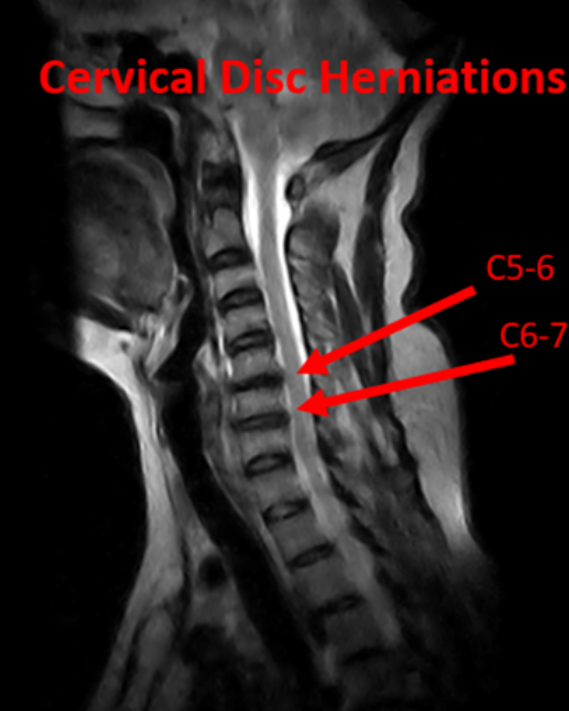 MRI scan of the cervical spine labeled “Cervical Disc Herniations,” with arrows pointing to disc issues at the C5–6 and C6–7 levels.