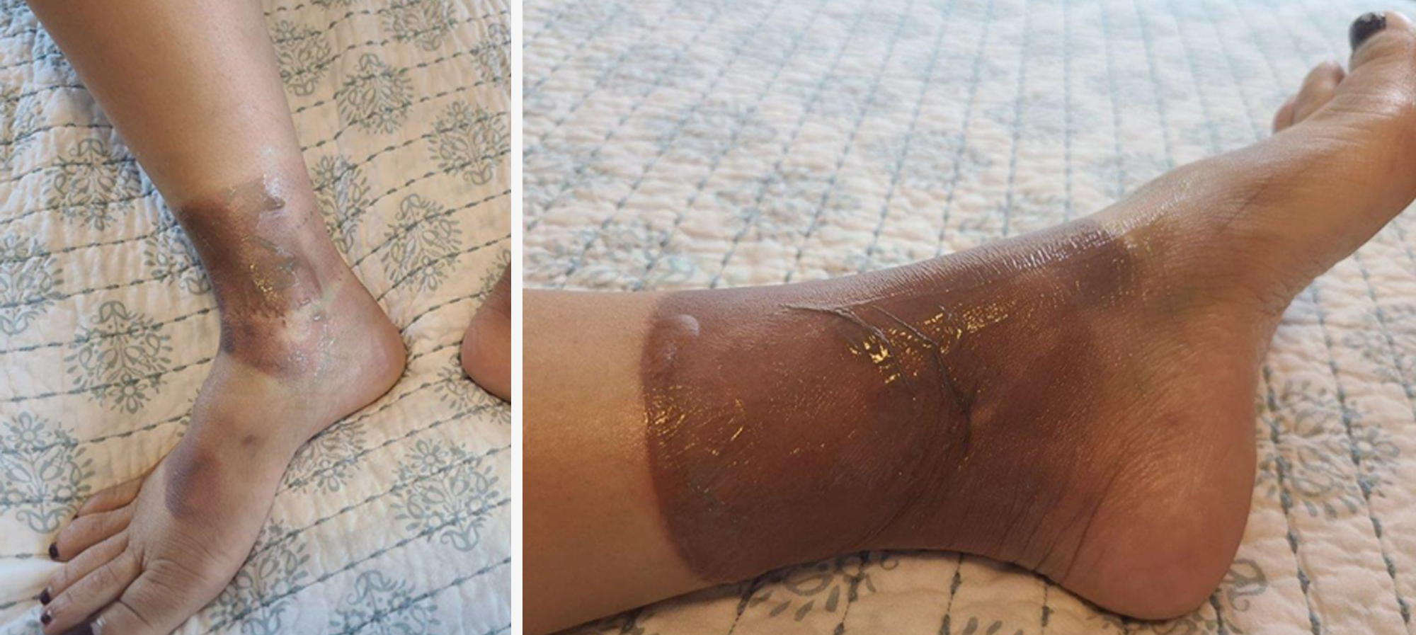 burn-victim-injured-in-apartment2