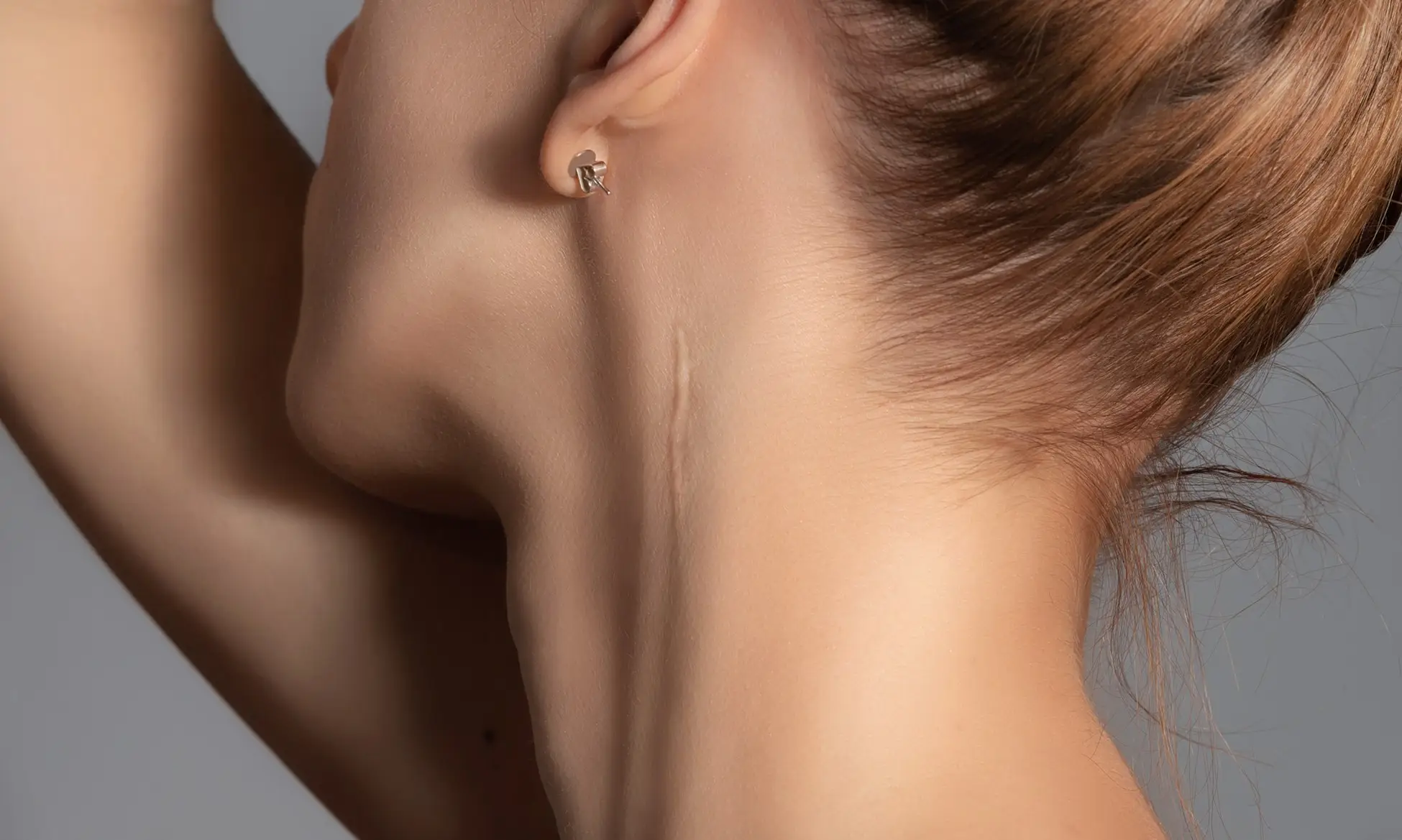 Disfigurement damages in Texas personal injury cases: what you must prove 1 Woman with visible neck scar illustrating disfigurement after a serious injury