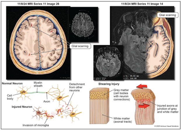 Resonancias magnéticas cerebrales con fecha del 8 de noviembre de 2024 que muestran cicatrices gliales derivadas de un traumatismo craneoencefálico, junto con diagramas que comparan neuronas sanas con neuronas dañadas y una lesión por cizallamiento en la unión entre la materia gris y la materia blanca.