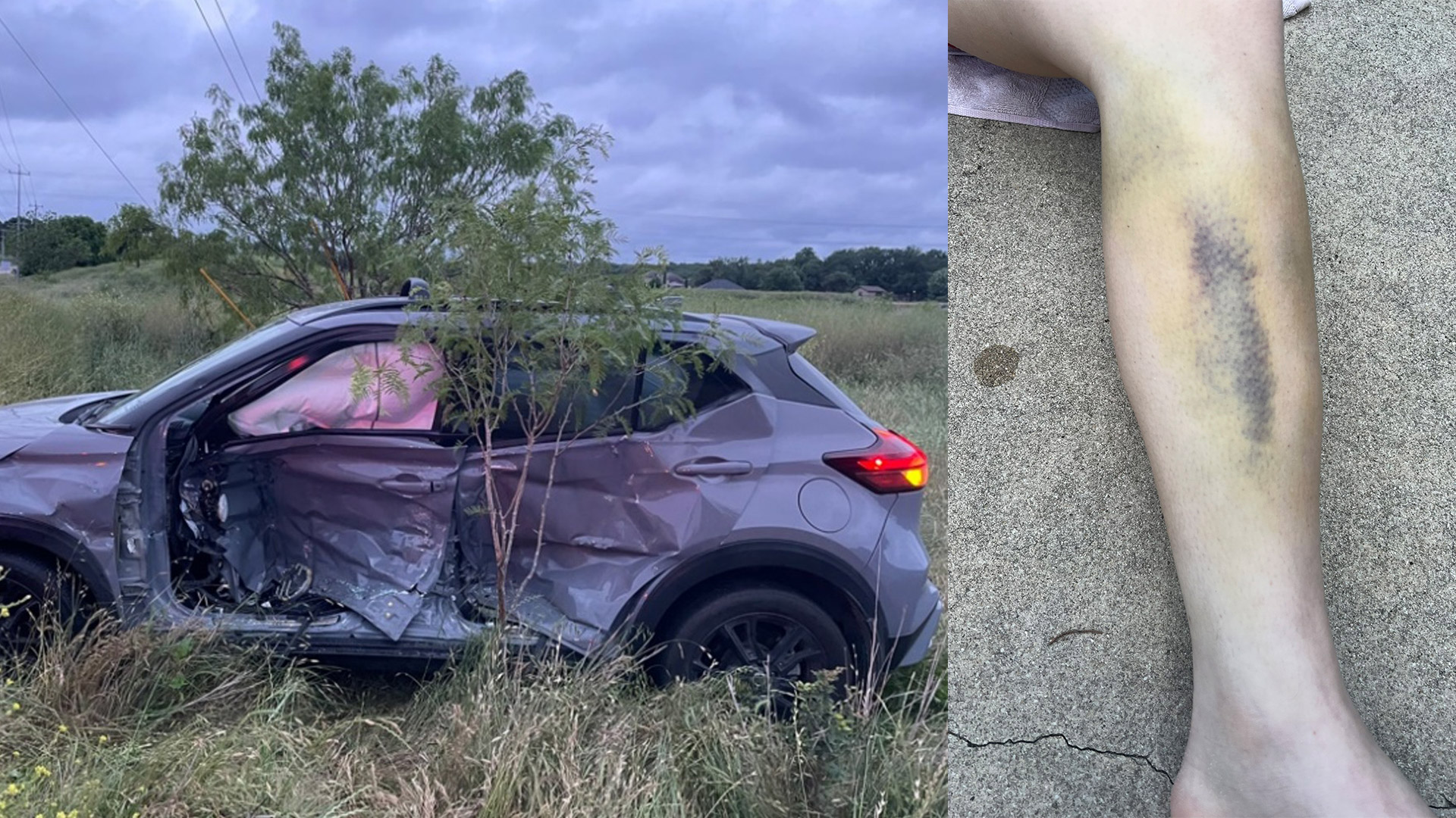 Fotografías del expediente del cliente de Crosley Law que muestran graves daños por intrusión en el lado del conductor del vehículo y hematomas importantes en la pierna del cliente tras el accidente