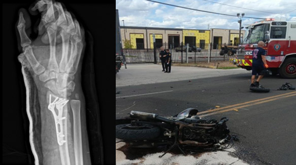 X-ray of a surgically repaired wrist with metal plate and screws alongside a photo of a destroyed motorcycle at the crash scene