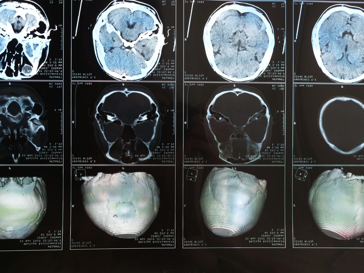 Grid of CT brain scan images showing multiple cross-sectional views of a human skull and brain