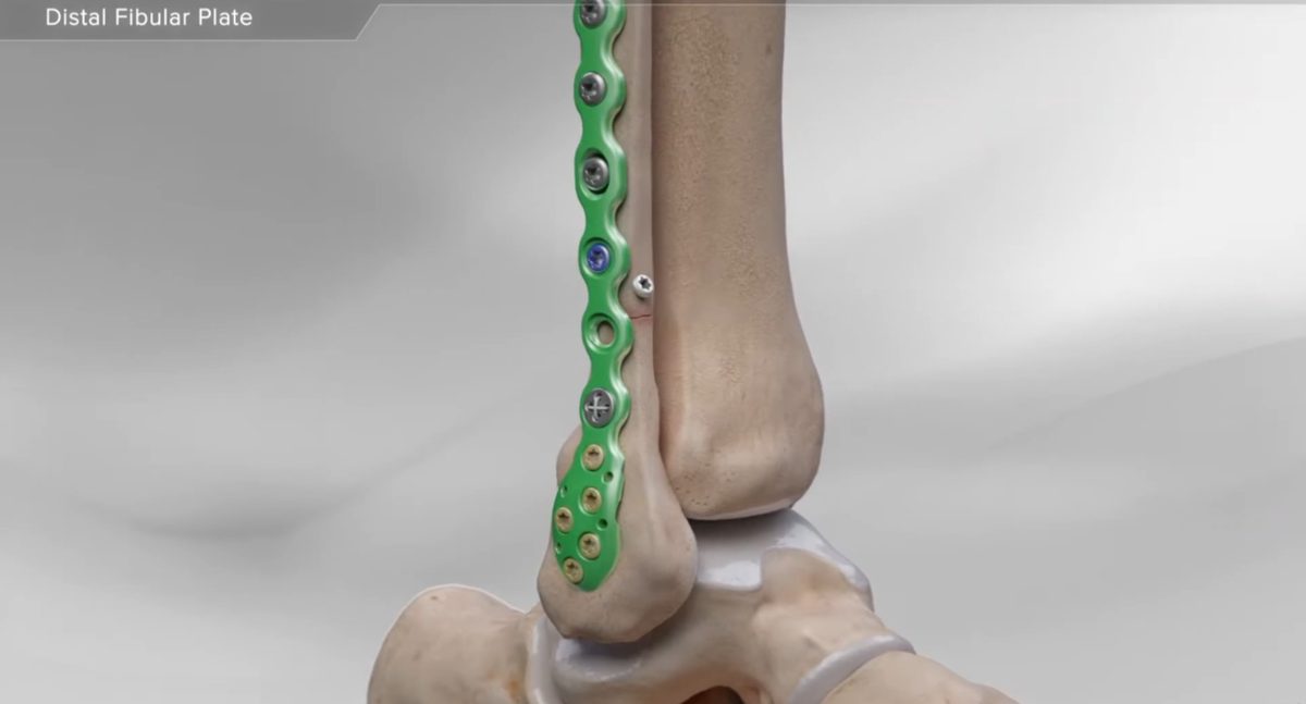 3D illustration of a distal fibular plate and screws repairing an ankle fracture like the client’s