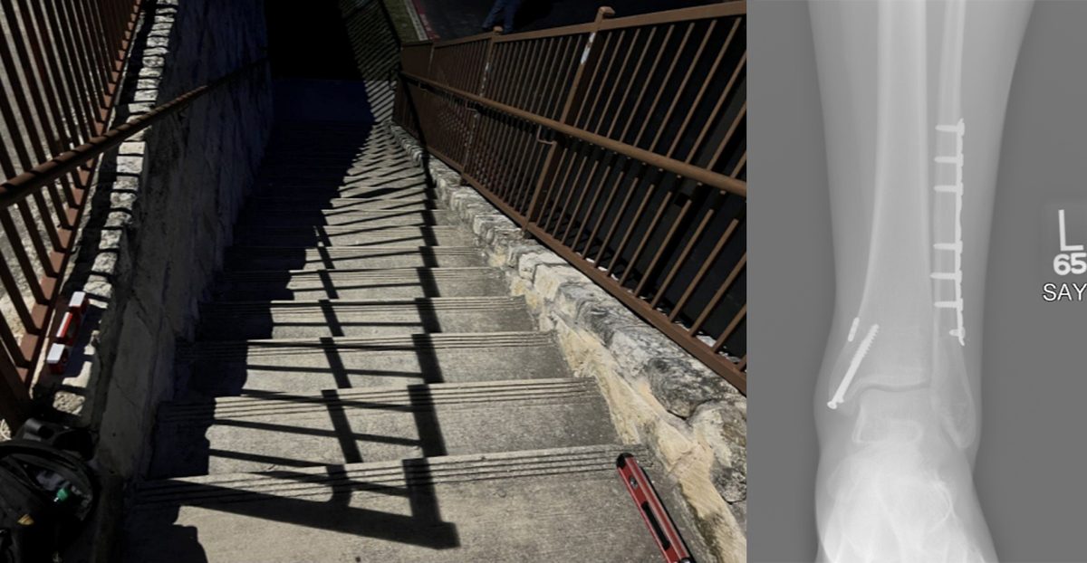 The dim apartment staircase where the client fell, beside an X-ray of her surgically repaired ankle with plate and screws