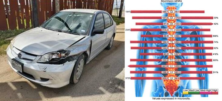 The client’s Honda Civic with front-end damage after the crash, beside an sEMG scan documenting his spinal injuries