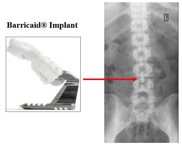 Barricaid® bone-anchored implant next to a lumbar spine X-ray, with a red arrow pointing to the device after surgery