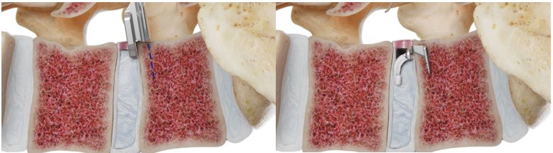 Illustration of a Barricaid® device anchored into vertebral bone to close the opening in a herniated lumbar disc