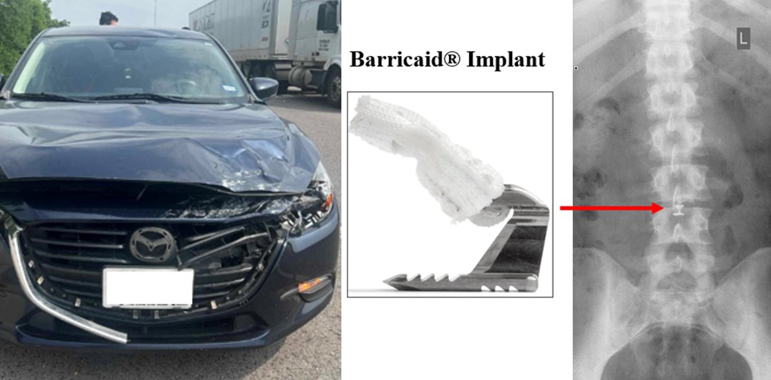 Damaged front end of a sedan after a stop sign crash beside a Barricaid® implant and an X-ray of it in the lumbar spine
